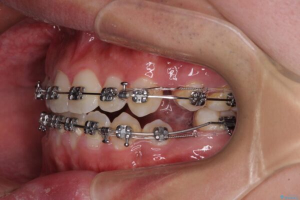 口元の突出感を改善　受け口傾向の咬み合わせの抜歯矯正 治療途中画像