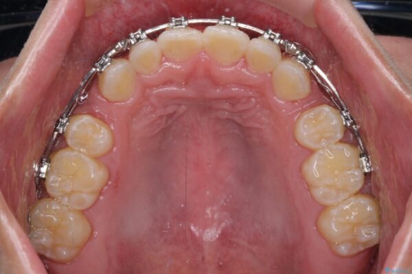 口元の突出感を改善　受け口傾向の咬み合わせの抜歯矯正 治療途中画像