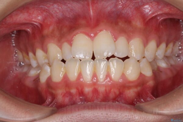 口元の突出感を改善　受け口傾向の咬み合わせの抜歯矯正 治療前画像