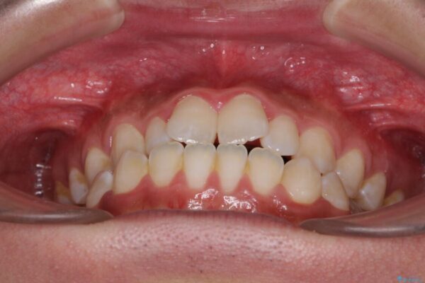 口元の突出感を改善　受け口傾向の咬み合わせの抜歯矯正 治療前画像