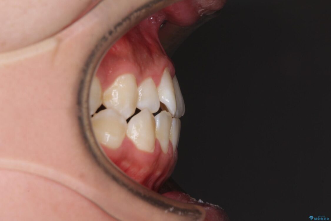 口元の突出感を改善　受け口傾向の咬み合わせの抜歯矯正 治療前