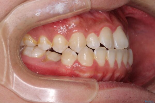 口元の突出感を改善　受け口傾向の咬み合わせの抜歯矯正 治療前画像