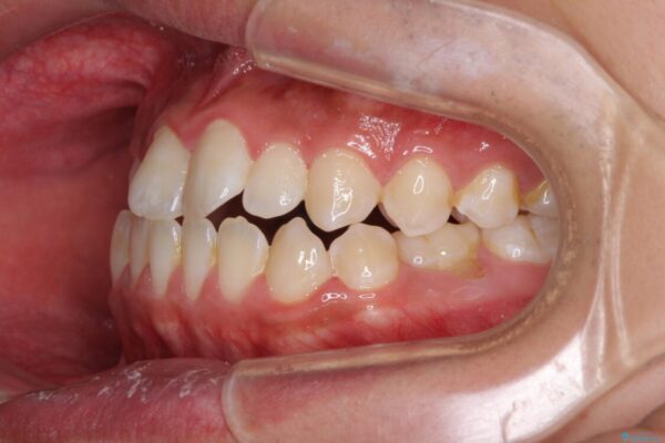 口元の突出感を改善　受け口傾向の咬み合わせの抜歯矯正 治療前画像