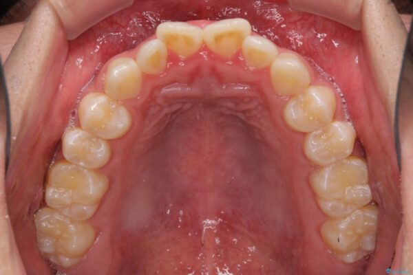 口元の突出感を改善　受け口傾向の咬み合わせの抜歯矯正 治療前画像