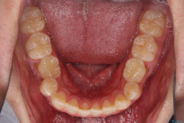 口元の突出感を改善　受け口傾向の咬み合わせの抜歯矯正 治療前画像