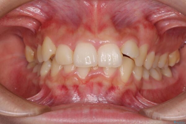 下顎前歯が隠れて突出した口元　ワイヤー装置での抜歯矯正 治療前画像