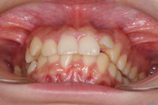 下顎前歯が隠れて突出した口元　ワイヤー装置での抜歯矯正 治療前画像