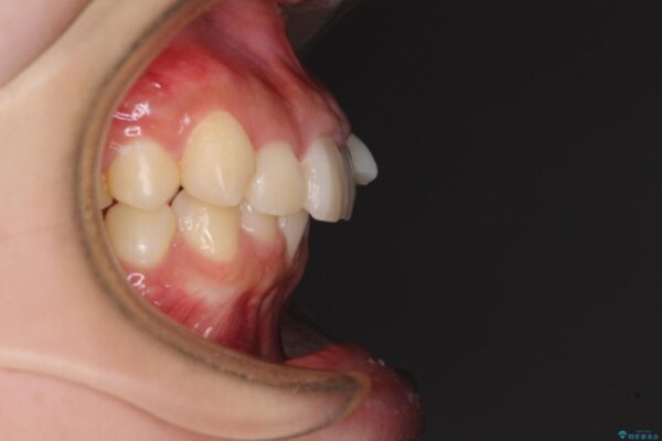 下顎前歯が隠れて突出した口元　ワイヤー装置での抜歯矯正 ビフォー