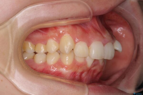 下顎前歯が隠れて突出した口元　ワイヤー装置での抜歯矯正 治療前画像