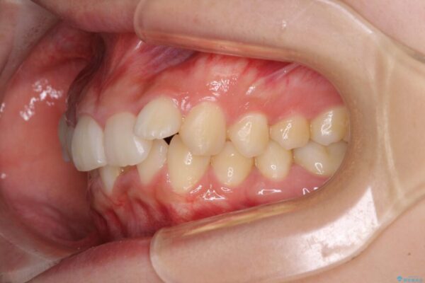 下顎前歯が隠れて突出した口元　ワイヤー装置での抜歯矯正 治療前画像