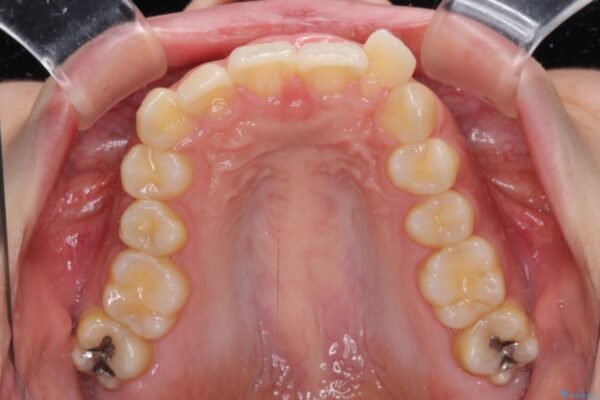 下顎前歯が隠れて突出した口元　ワイヤー装置での抜歯矯正 治療前画像