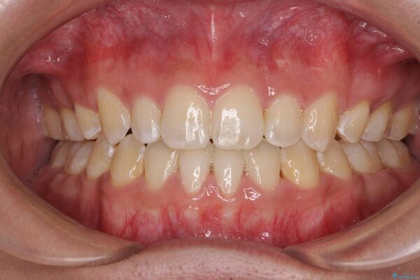 口元の突出感を改善　受け口傾向の咬み合わせの抜歯矯正 治療後画像