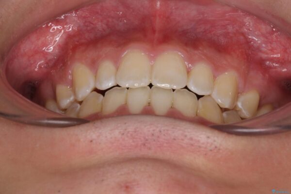 口元の突出感を改善　受け口傾向の咬み合わせの抜歯矯正 治療後画像