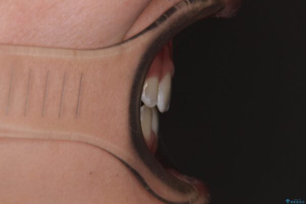 口元の突出感を改善　受け口傾向の咬み合わせの抜歯矯正 アフター