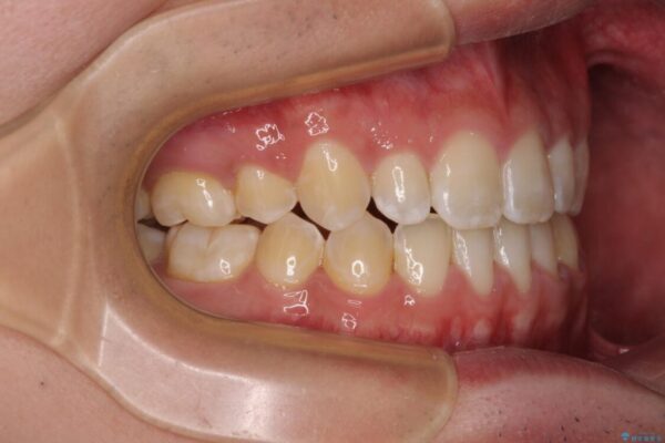 口元の突出感を改善　受け口傾向の咬み合わせの抜歯矯正 治療後画像
