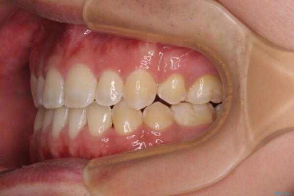 口元の突出感を改善　受け口傾向の咬み合わせの抜歯矯正 治療後画像