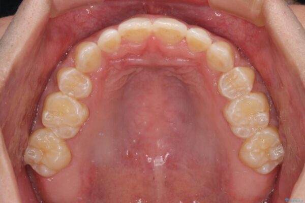 口元の突出感を改善　受け口傾向の咬み合わせの抜歯矯正 治療後画像