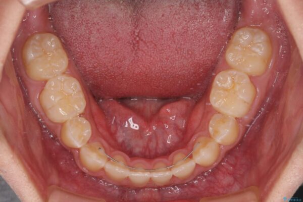 口元の突出感を改善　受け口傾向の咬み合わせの抜歯矯正 治療後画像