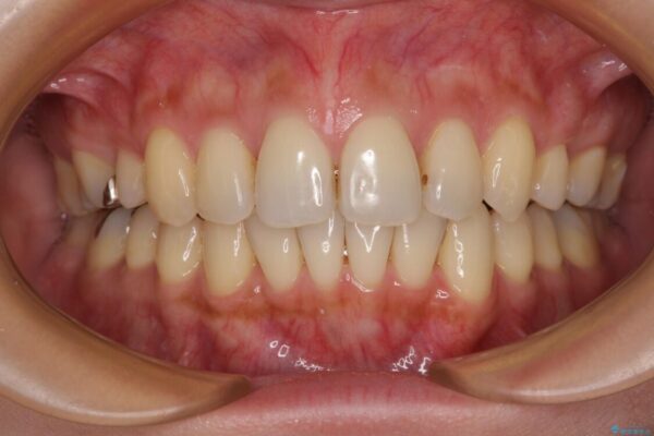 上顎前歯の突出を軽減　インビザラインによる抜歯矯正 治療後画像