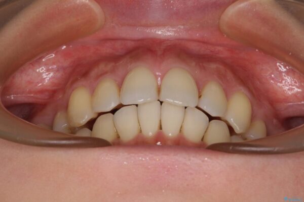 上顎前歯の突出を軽減　インビザラインによる抜歯矯正 治療後画像