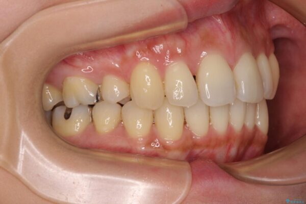 上顎前歯の突出を軽減　インビザラインによる抜歯矯正 アフター