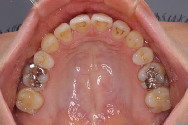 上顎前歯の突出を軽減　インビザラインによる抜歯矯正 治療後画像