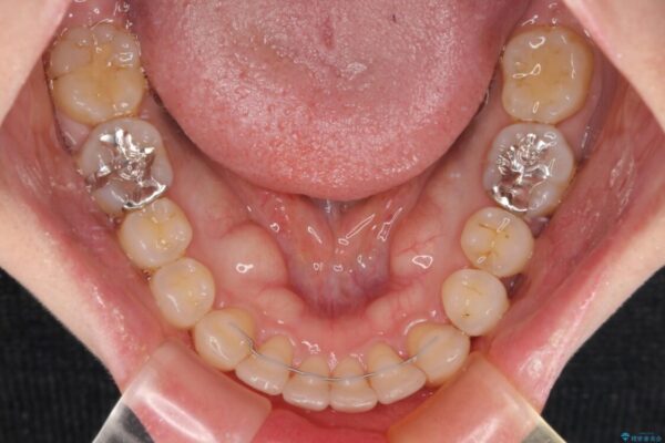 上顎前歯の突出を軽減　インビザラインによる抜歯矯正 治療後画像