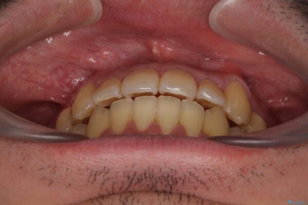 八重歯とクロスバイト　目立たないワイヤー装置で矯正治療 治療後画像
