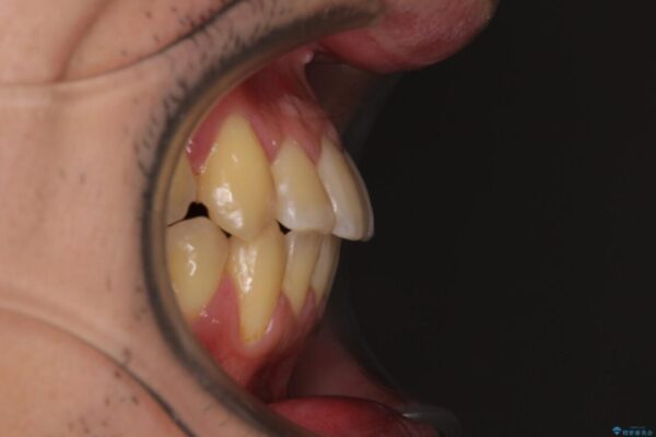 八重歯とクロスバイト　目立たないワイヤー装置で矯正治療 治療後画像