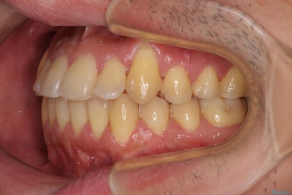 八重歯とクロスバイト　目立たないワイヤー装置で矯正治療 治療後画像