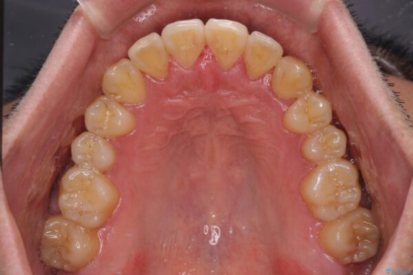 八重歯とクロスバイト　目立たないワイヤー装置で矯正治療 治療後画像