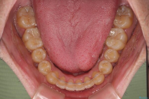 八重歯とクロスバイト　目立たないワイヤー装置で矯正治療 治療後画像