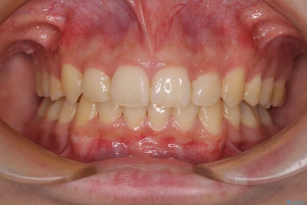 下顎前歯が隠れて突出した口元　ワイヤー装置での抜歯矯正 治療後画像