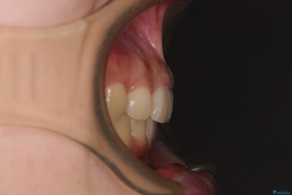 下顎前歯が隠れて突出した口元　ワイヤー装置での抜歯矯正 アフター