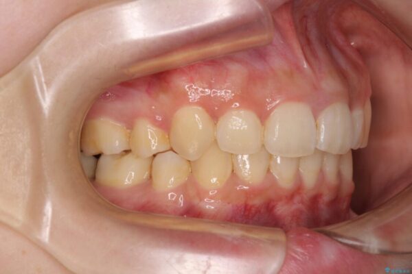 下顎前歯が隠れて突出した口元　ワイヤー装置での抜歯矯正 治療後画像