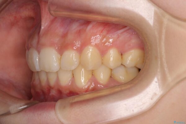 下顎前歯が隠れて突出した口元　ワイヤー装置での抜歯矯正 治療後画像