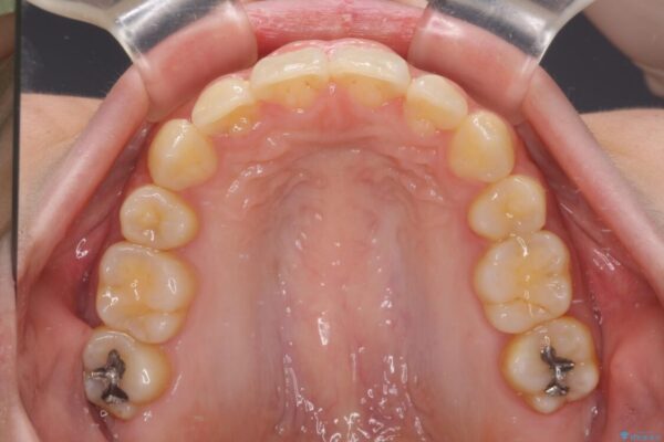 下顎前歯が隠れて突出した口元　ワイヤー装置での抜歯矯正 治療後画像