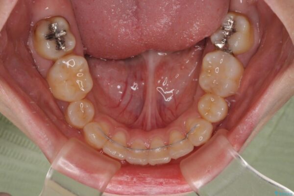 下顎前歯が隠れて突出した口元　ワイヤー装置での抜歯矯正 治療後画像