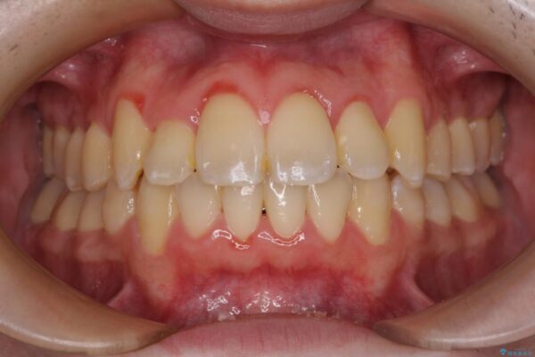 全顎的なクロスバイト　補助装置を用いてワイヤー矯正 アフター