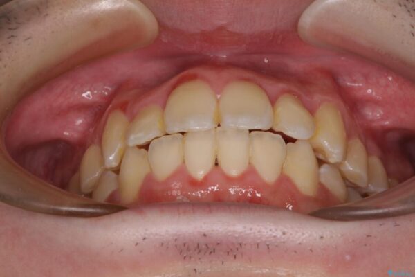 全顎的なクロスバイト　補助装置を用いてワイヤー矯正 治療後画像