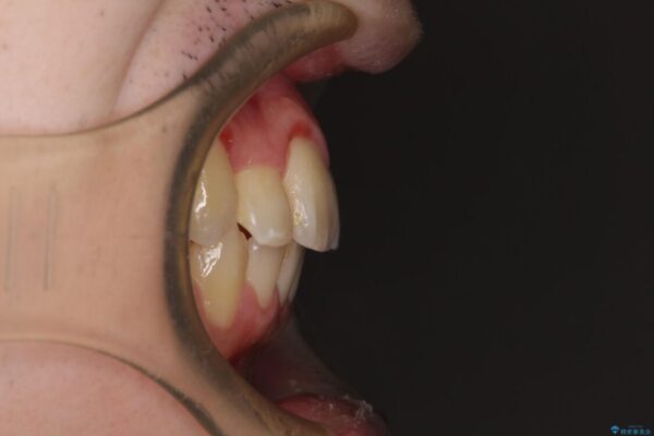 全顎的なクロスバイト　補助装置を用いてワイヤー矯正 治療後画像