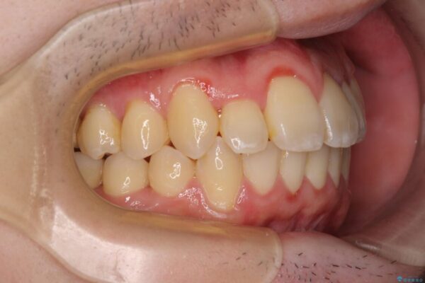 全顎的なクロスバイト　補助装置を用いてワイヤー矯正 治療後画像