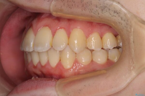 全顎的なクロスバイト　補助装置を用いてワイヤー矯正 治療後画像