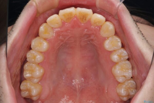 全顎的なクロスバイト　補助装置を用いてワイヤー矯正 治療後画像