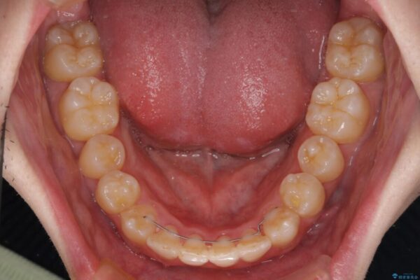 全顎的なクロスバイト　補助装置を用いてワイヤー矯正 治療後画像