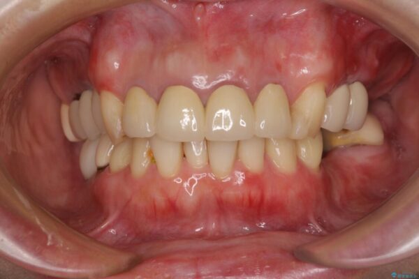 仮歯のまま放置した前歯　オールセラミッククラウンで自然な前歯に 治療後画像