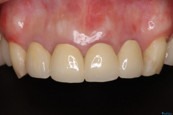 仮歯のまま放置した前歯　オールセラミッククラウンで自然な前歯に アフター