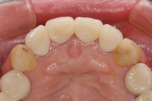 仮歯のまま放置した前歯　オールセラミッククラウンで自然な前歯に 治療後画像