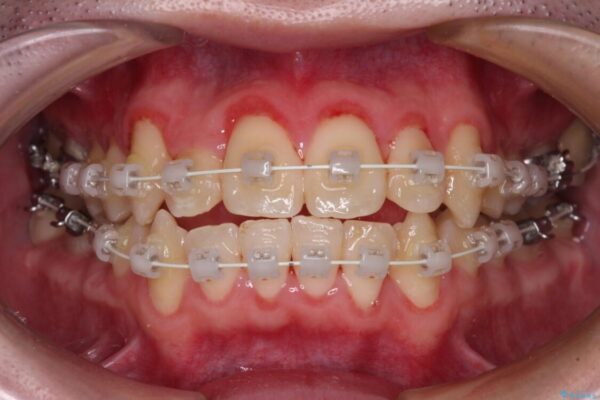 全顎的なクロスバイト　補助装置を用いてワイヤー矯正 治療途中画像