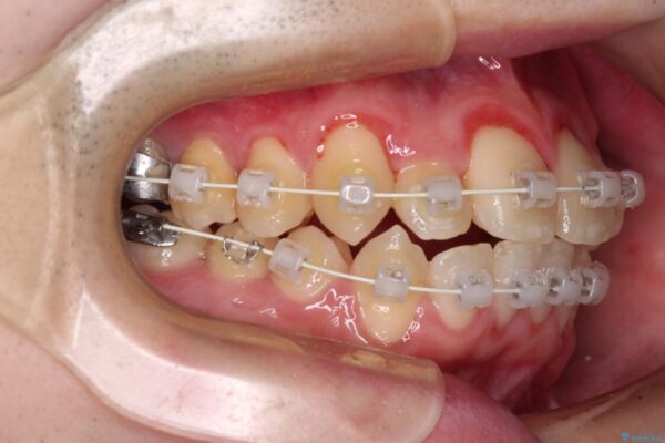 全顎的なクロスバイト　補助装置を用いてワイヤー矯正 治療途中画像